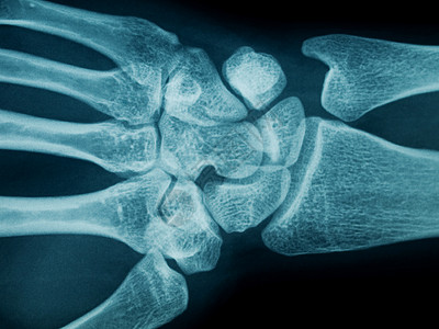 舟骨手腕X光手指头状辐射电影骨骼生物学放射科女性三角骨事故背景