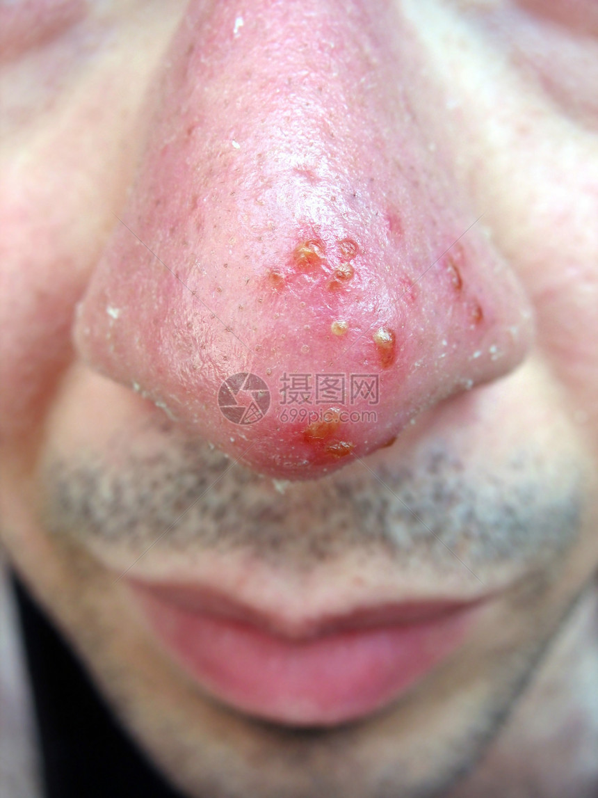 鼻鼻子冷酸鼻子嘴唇晒斑结痂水泡感染治疗皮肤科拭子单纯形图片