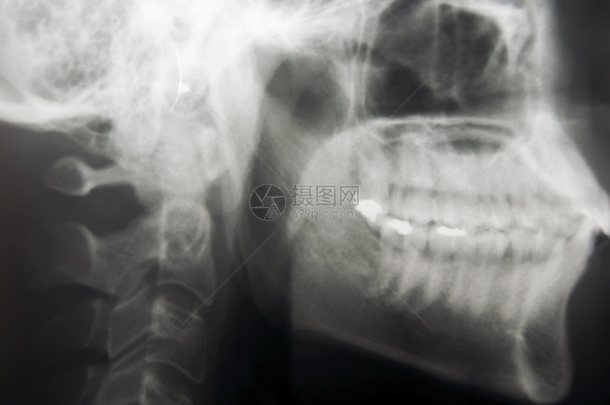 Skull X光扫描骨骼辐射颅骨考试x光医疗白色图片