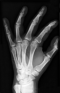 X射线手腕关节手指手腕软骨射线x光关节病痛风刀门背景