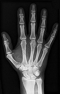 X射线手射线手指腕关节痛风刀门手腕软骨关节病x光背景