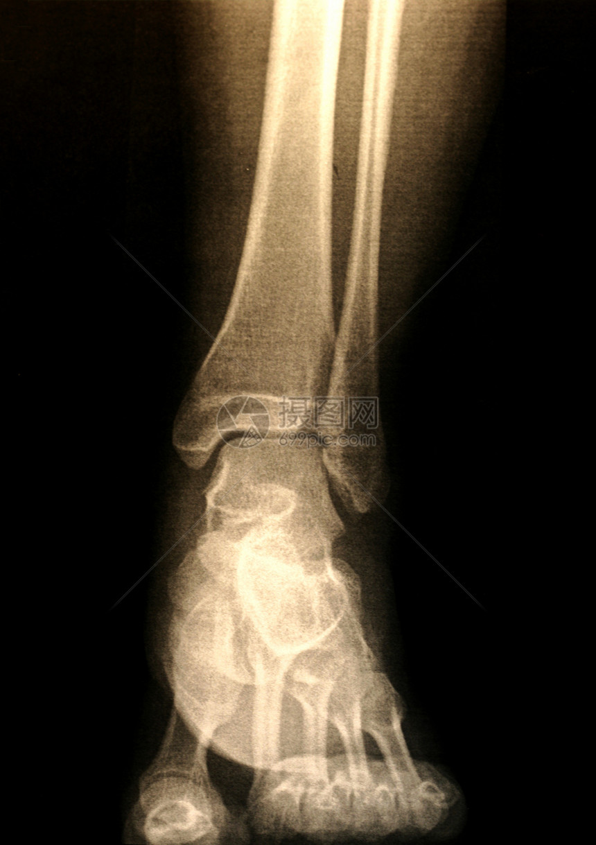 脚X光医疗放射科解剖学x光身体x射线图片