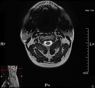 磁共振成像系列神经元乐队捷运健康颈椎病麝香脖子身体辐射颈椎背景图片