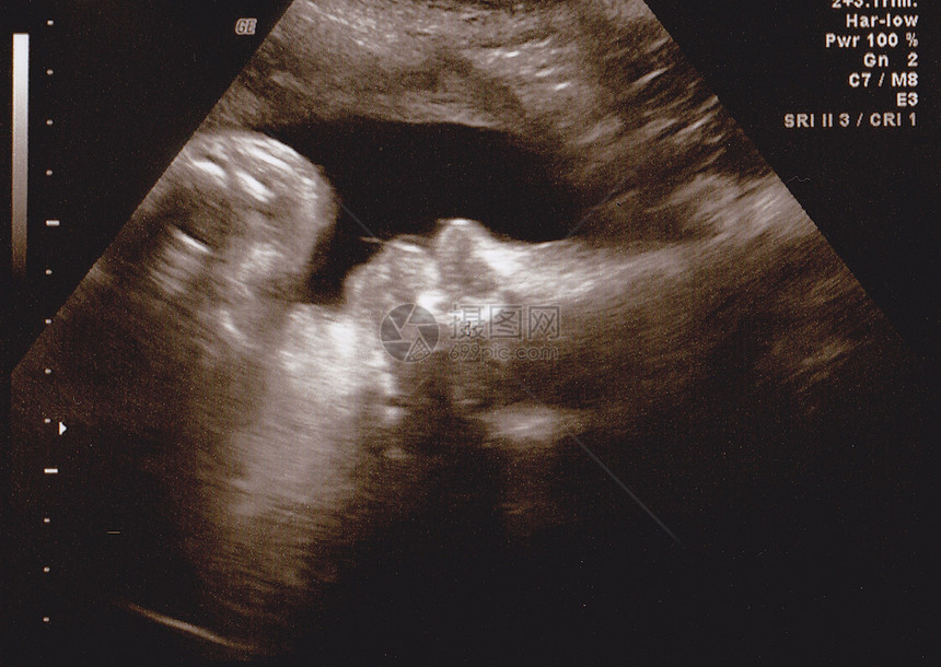 胎儿医疗声波图图片