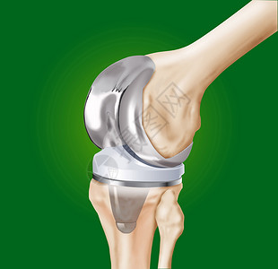 膝盖的假肢关节医院治疗医师股骨手术骨头骨科外科胫骨背景图片