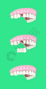 牙科假牙植入术高清图片