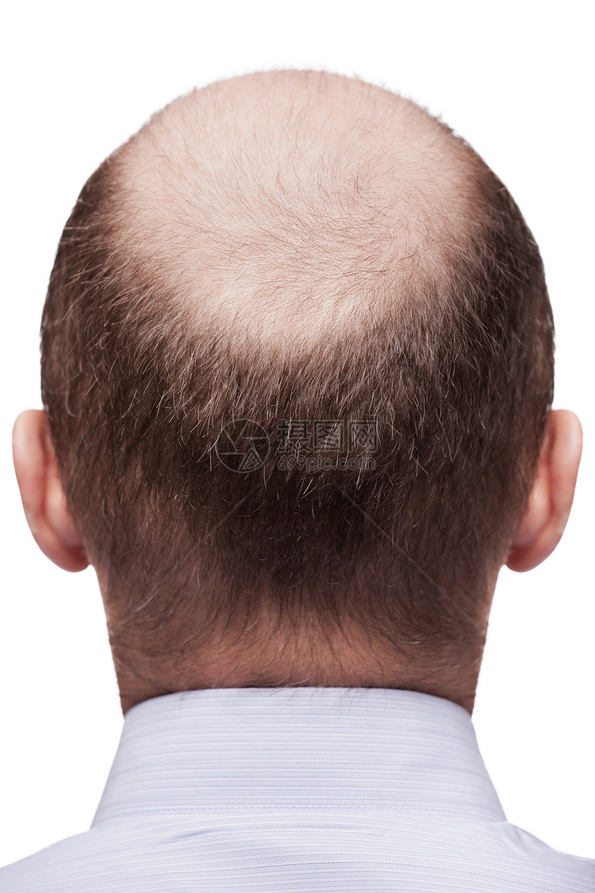 秃头人头卫生白色脱发保健药品枕骨皮肤损失黑色发型图片