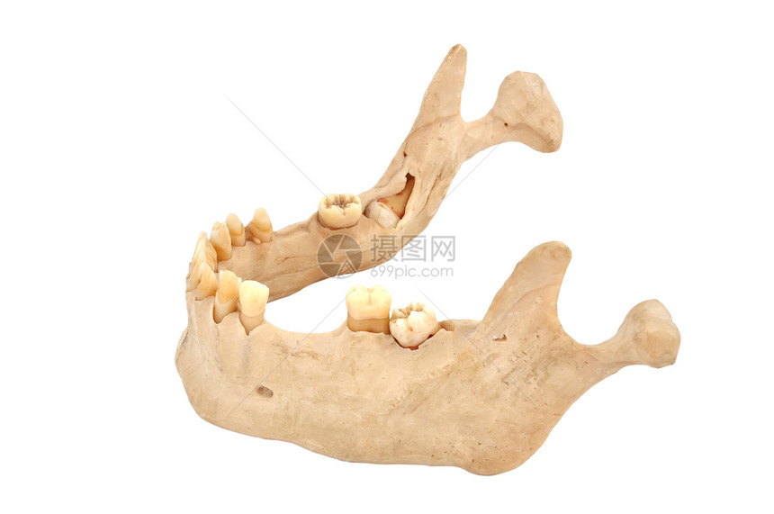 下颌假肢保健卫生牙科树桩塑料牙齿牙周口腔科臼齿图片