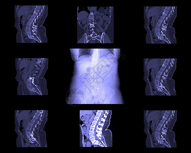 脊柱手术计算脊椎断层造影手术脊柱库存骨头诊断疾病照片身体铁饼髓质背景
