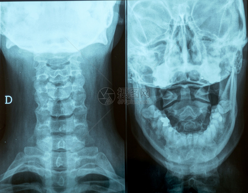 头部射线摄影图片
