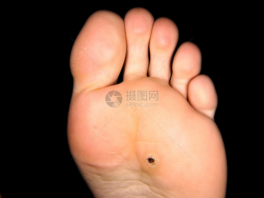 黑斑马徒步行走背景温泉医疗治疗身体加厚角化男人脚趾女性图片
