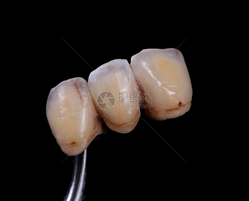 完成的陶瓷前冠 黑色背景治疗卫生门牙实验室病人牙齿树桩工作牙医生产图片