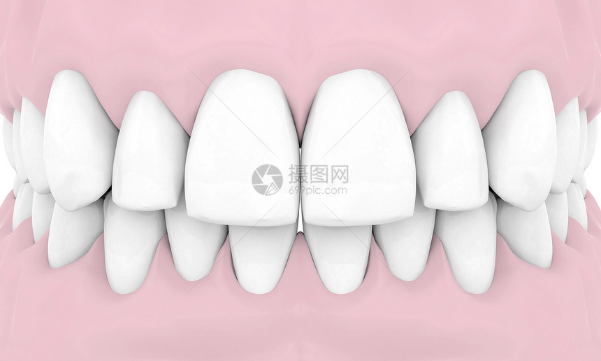 牙科移植白色假牙外科技术合金别针搪瓷牙医医疗凹痕图片