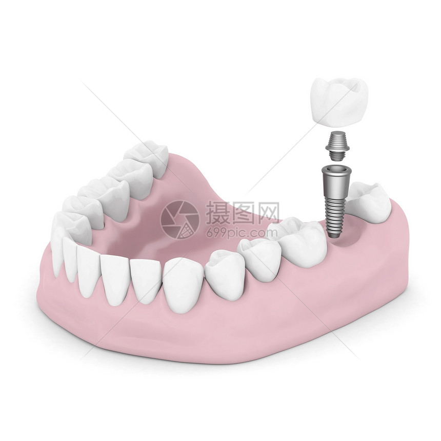 牙科移植白色牙医外科搪瓷医疗合金药品金属技术手术图片