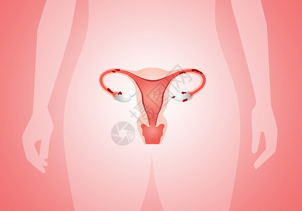 膜的子宫内硬化治愈卫生丝带斗争药品女性疾病粉色治疗疼痛背景