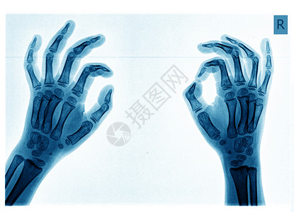 X射线手拇指手腕创伤x光身体风湿病医院射线状况诊断背景图片