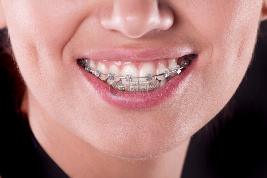 有牙套的 紧闭起来矫正支撑女孩牙医微笑卫生幸福宏观快乐成人图片