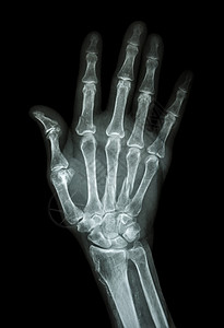 手腕骨折多重骨折 在指数 小手指 肌肉骨骨前臂保健解剖学病人放射科x射线骨科手臂医院药品背景