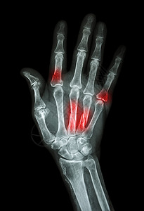 手腕骨折多重骨折 在指数 小手指 肌肉骨骨棕榈碰撞x射线骨骼病人诊断保健医院卫生射线背景