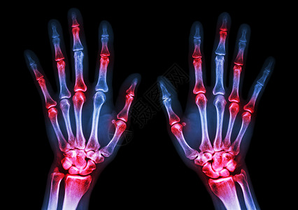 多关节淋巴 风湿的人体手和关节炎手腕保健病人骨骼电影棕榈骨科痛风卫生蓝色背景图片