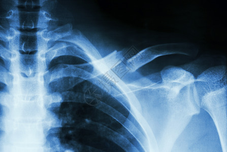 骨折病人左颈骨折肩膀解剖学x射线药品治疗射线卫生医生胸部骨骼背景