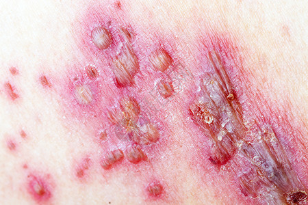 丘疹性荨麻疹疹青杉疱疹病毒性划痕表皮医疗皮肤科感染皮疹瘟疫麻疹背景