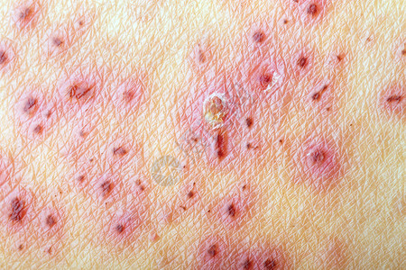 带状疱疹 带状疱疹  治疗后皮肤瘟疫麻疹表皮荨麻疹感染皮肤科红色皮疹症状背景图片