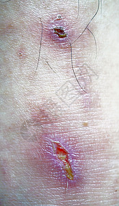 腿受伤泥沼脓肿疼痛浮肿损害伤口发红背景图片