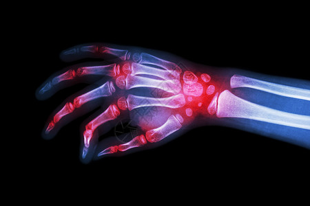 类风湿性关节炎 痛风性关节炎 多关节关节炎患儿的 X 光片手扫描前臂半径风湿指骨手臂手腕创伤腕骨蓝色背景图片