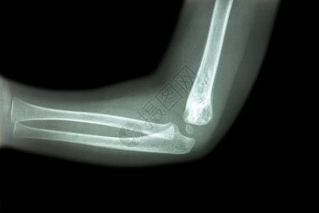 宝宝骨骼儿童肘部正常儿童肘部X光片侧视 横向扫描x射线前臂骨骼解剖学诊断病人手臂医院外科背景