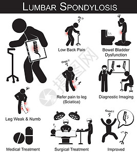侧弯症状象形图(低背痛 将疼痛指向腿部 腿麻木和虚弱 鲍尔膀胱机能障碍)和医疗 外科治疗设计图片