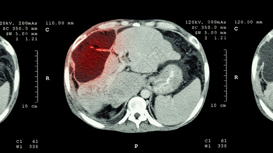 断层扫描上腹部CT扫描 肝脏显示异常质量肝癌指针脊柱肝细胞调查电脑癌症器官电影保健医生背景