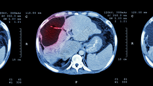 脊柱疾病上腹部CT扫描 肝脏显示异常质量肝癌调查疾病医院蓝色标签放射科病人药品保健电影背景