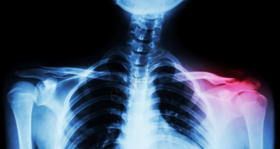 电影片X光两张锁骨AP前视 左颈骨折身体创伤病人解剖学事故手术调查诊断医生蓝色背景图片
