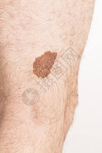 肝血管瘤间皮瘤血管美容标记印迹男人红痣状况胎记病变皮肤科保健药品表皮背景