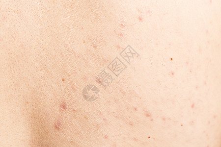 男性背部的皮疹治疗青少年皮肤科护理化妆品粉刺青年疙瘩皮肤背景图片