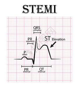 ST抬高心肌梗死心电图 STEMI心电图细节 P波 PR段 PR间期 QRS复合体 QT间期 ST抬高T波 急性冠脉综合征心绞痛插画