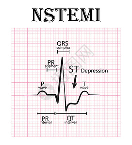 非 ST 段抬高心肌梗死心电图 NSTEMI 心电图细节插画