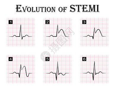 STEMI ST段抬高心肌梗死 急性冠脉综合征心绞痛的演变 逐步 心电图插画
