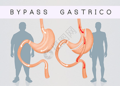 减少胃部的胃道切除术保健插图减肥男人肥胖卫生外科肠子器官饮食背景图片