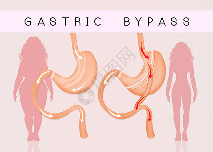 减少胃部的胃道切除术女性饮食插图外科保健卫生减肥女士器官肥胖背景图片
