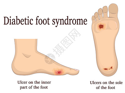 后果糖尿病足综合症设计图片