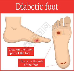 后果糖尿病足设计图片
