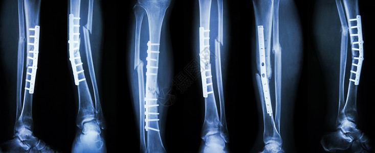 收集腿骨折和外科手术的图象 用盘子和螺丝进行内部固定 断裂蒂比亚和纤维骨医院电影医生卫生保健胫骨裂缝创伤收藏骨骼背景图片