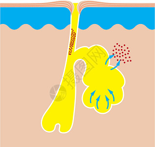 皮脂分泌Acne 粗俗或小酒窝形成过程感染治疗真皮编队细胞喜剧片生理粉刺乳突头发插画