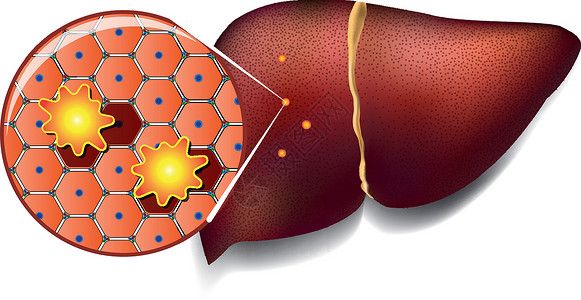 纤维化被毒素攻击的肝细胞身体肥胖卫生组织肝硬化排毒坏死癌症肠胃小叶插画