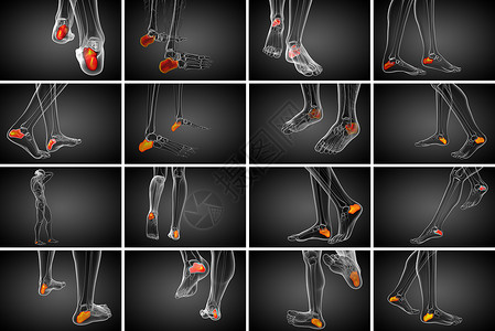 3d 医学上展示了大口径的骨骼3d痛风风湿痛苦跟骨创伤病人骨科渲染医疗背景图片