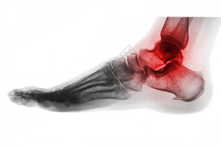 足跟疼痛脚踝关节炎 脚部X光片 横向视图 反颜色风格跟骨跗骨创伤扫描x射线骨骼病人放射科骨科痛风背景