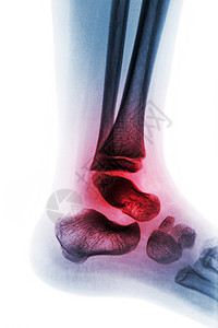 足跟疼痛扭伤扫描高清图片