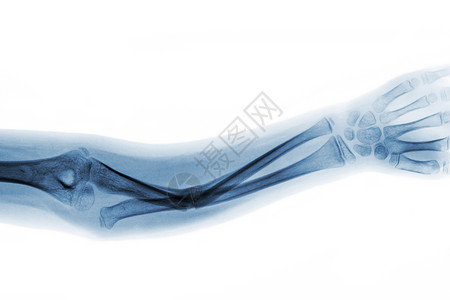 apAP显示脉轮骨骨折断轴扫描放射科前臂骨骼畸形半径病人弯头蓝色x射线背景